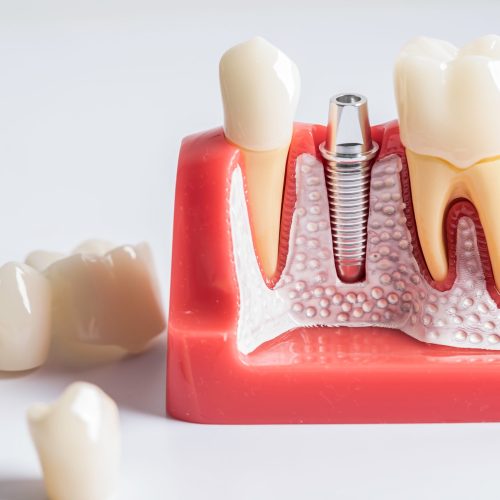 Dental implant, artificial tooth roots into jaw, root canal of dental treatment, gum disease, teeth model for dentist studying about dentistry.